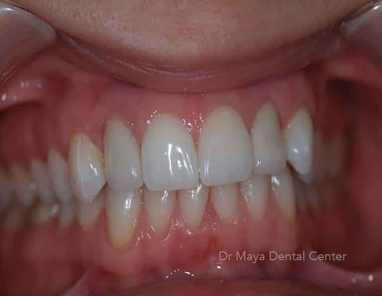 Crowns 2 after