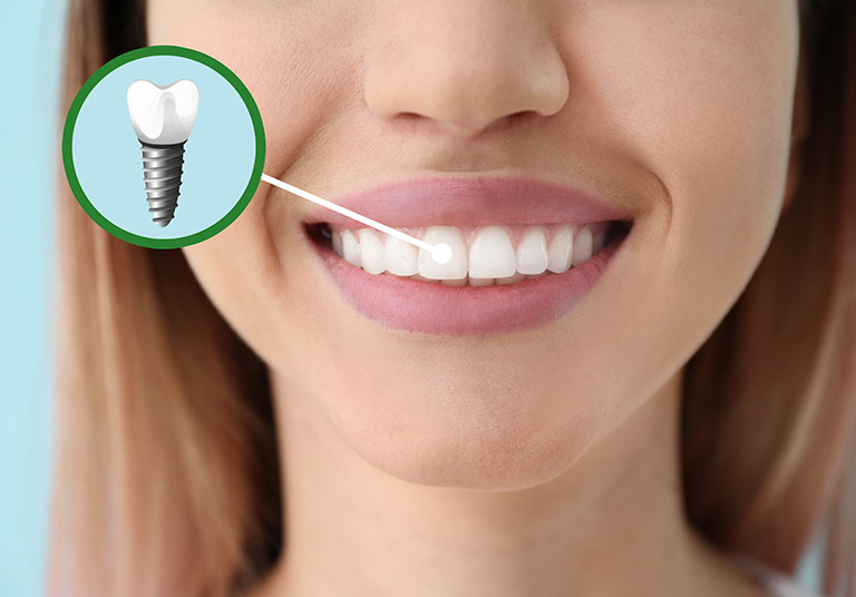 Dental Implants
