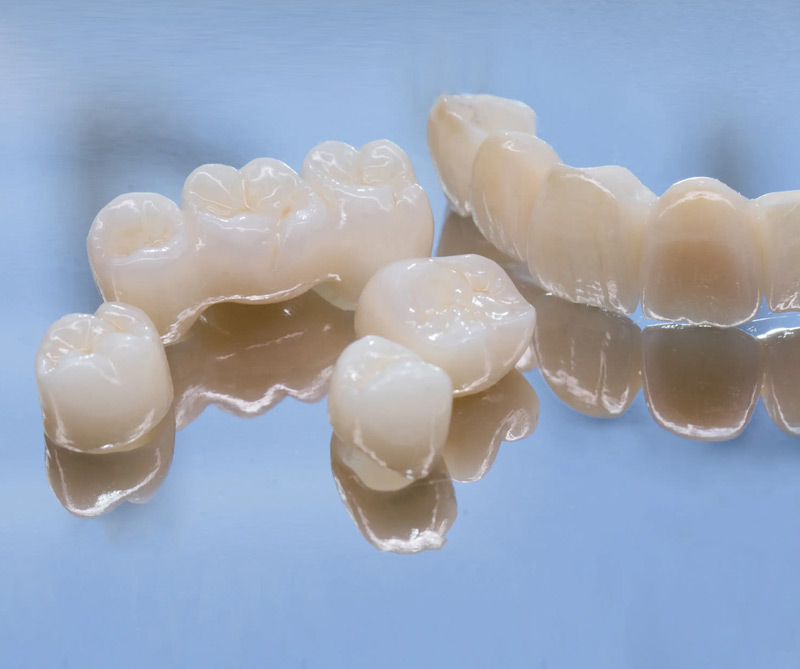 Full Porcelain Crowns and Bridges