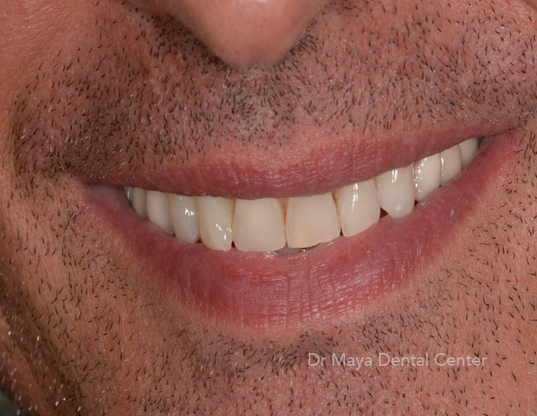 Implant 1 after