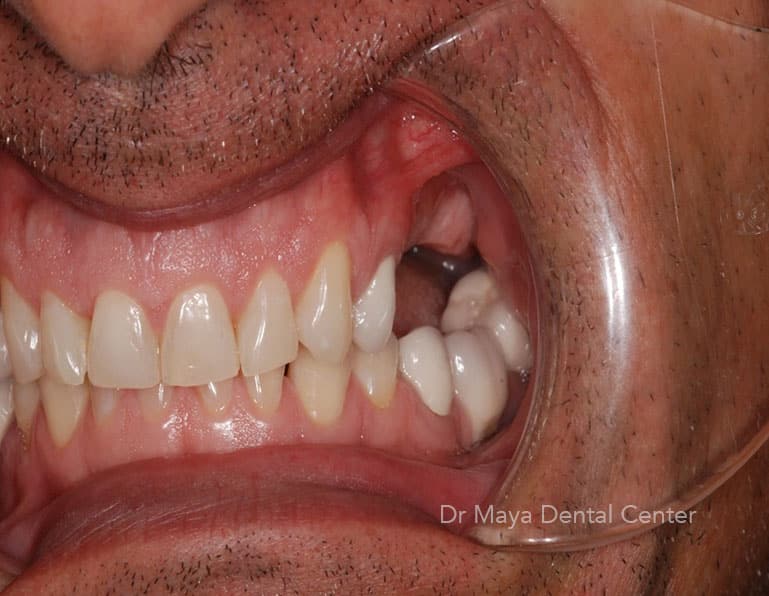 Implant 1 before