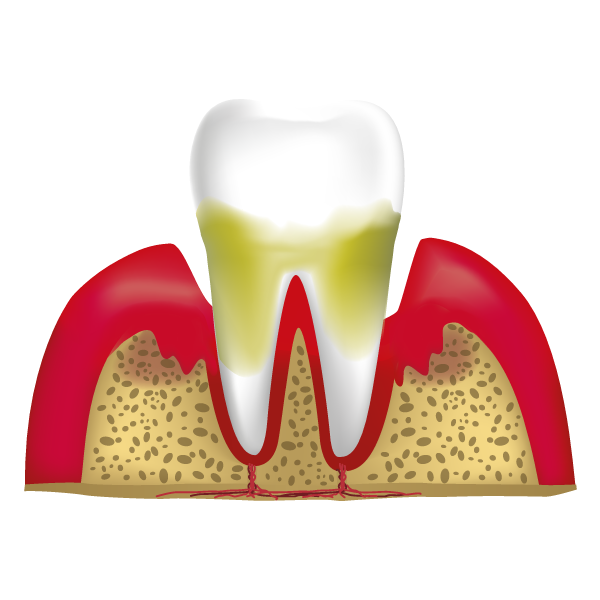 Stage Four - Advanced Periodontal Disease