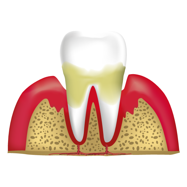 Stage Three - Moderate Periodontal Disease