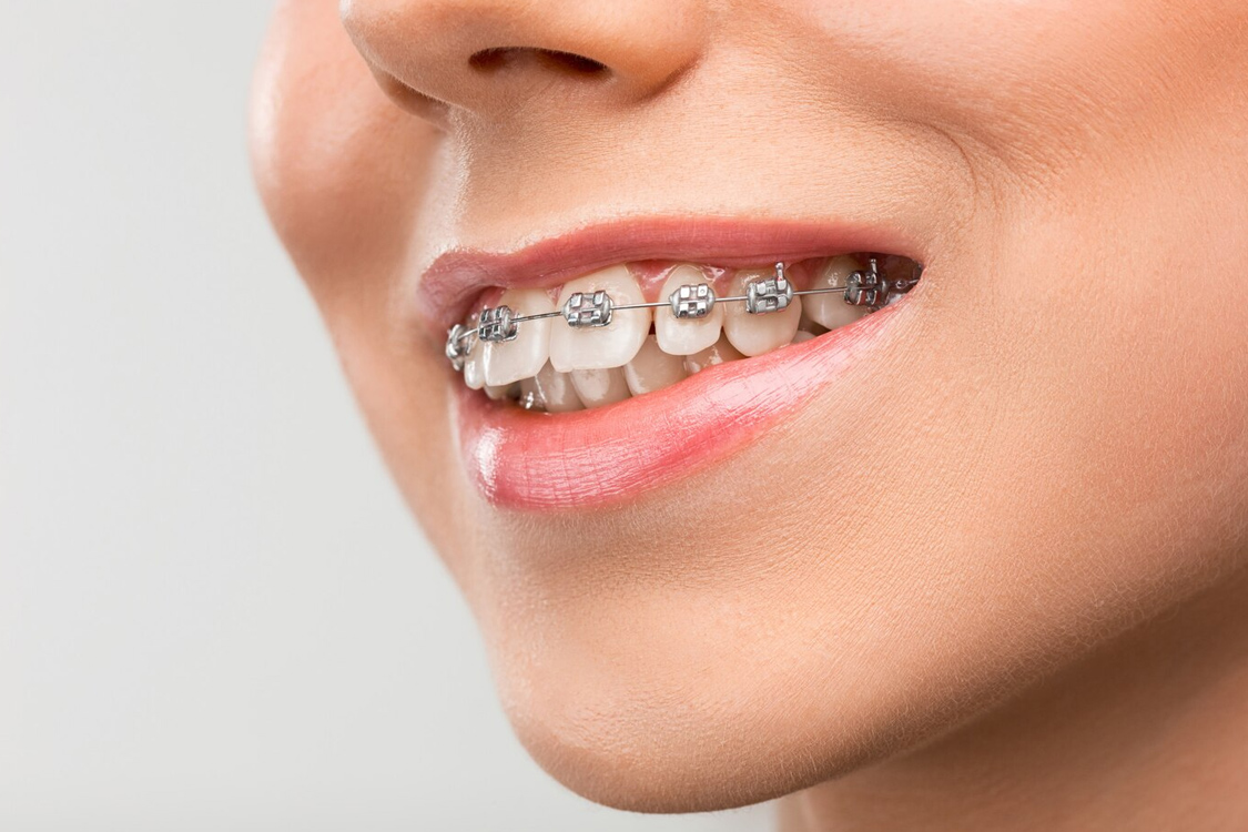 Early Intervention, Lifelong Benefits: Exploring the World of Interceptive Orthodontics!