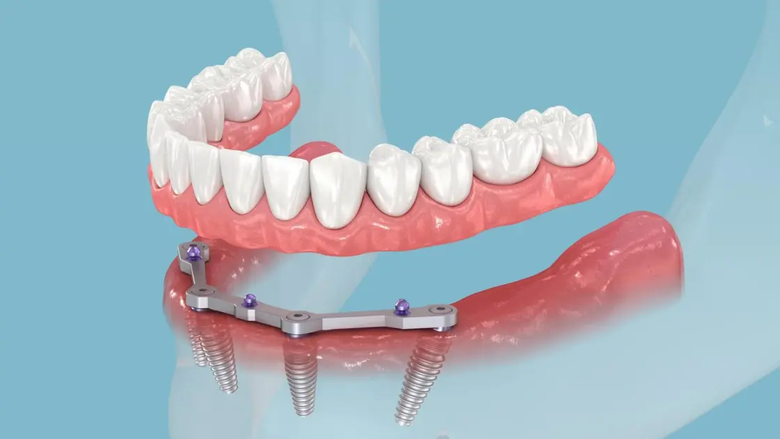 The Top Misconceptions About Dental Implants