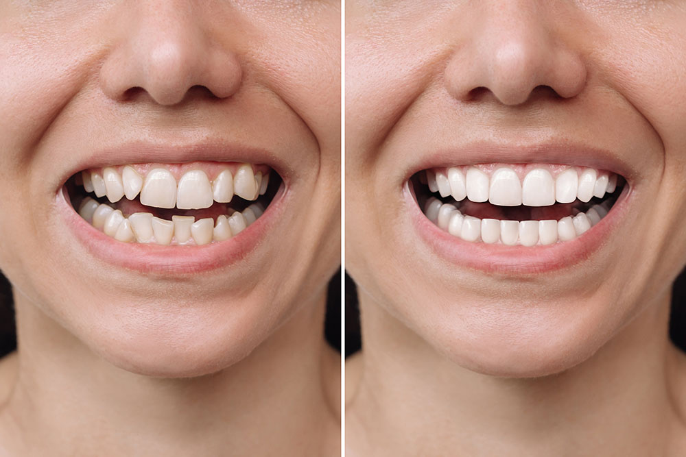 Porcelain Veneers For Crooked Or Chipped Teeth