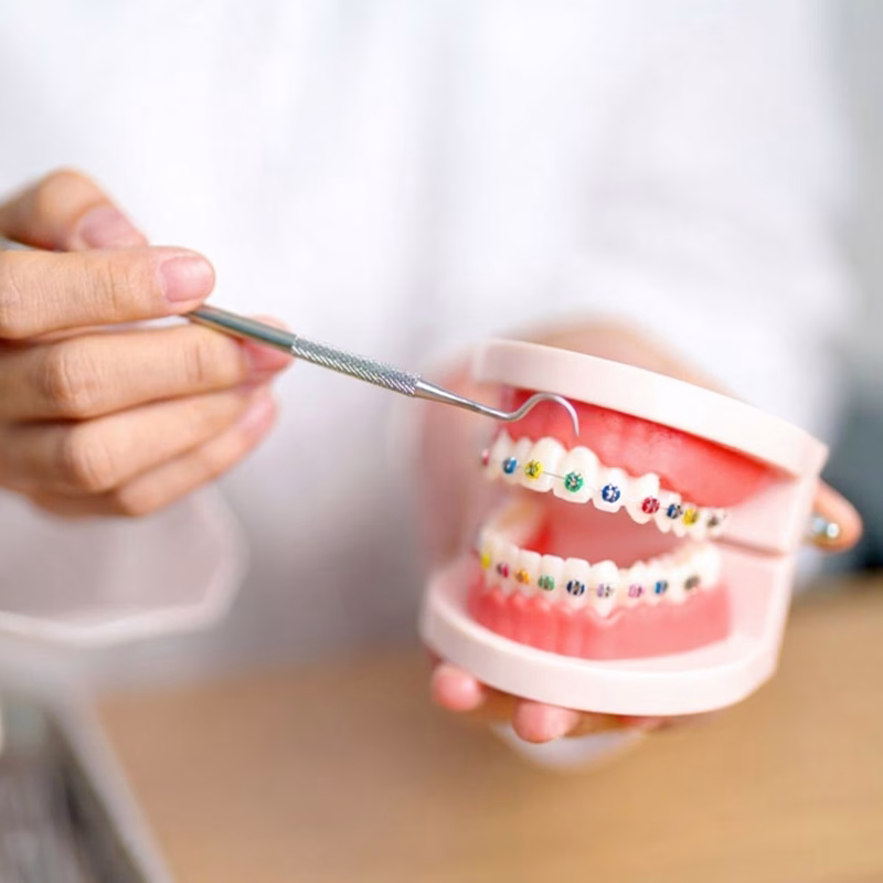 Types of Braces We Offer