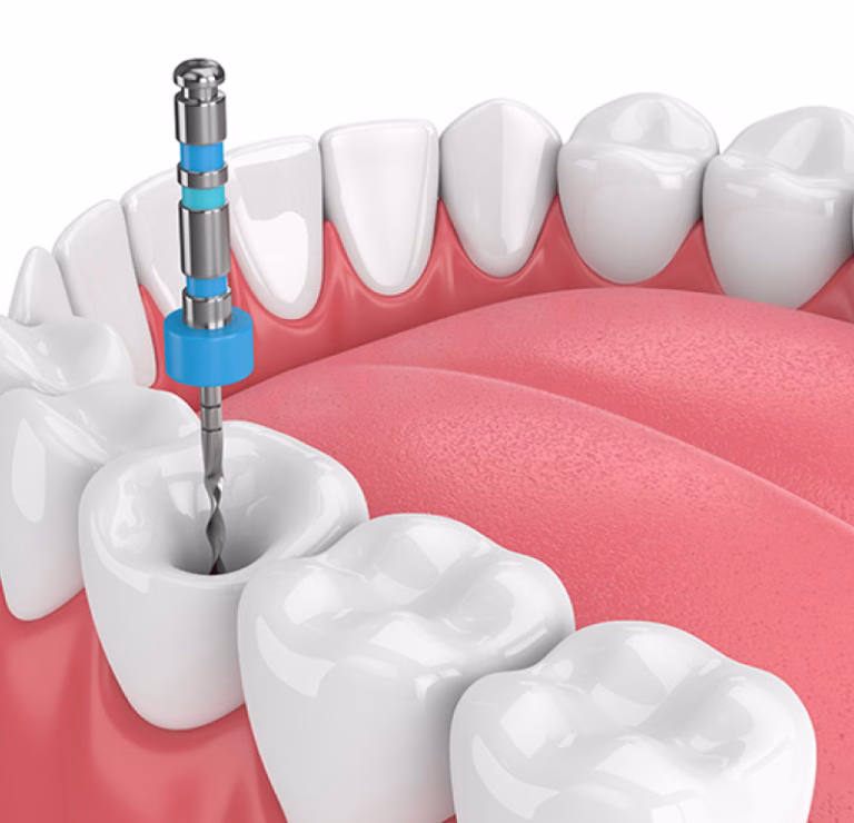 Why Root Canal Treatment?