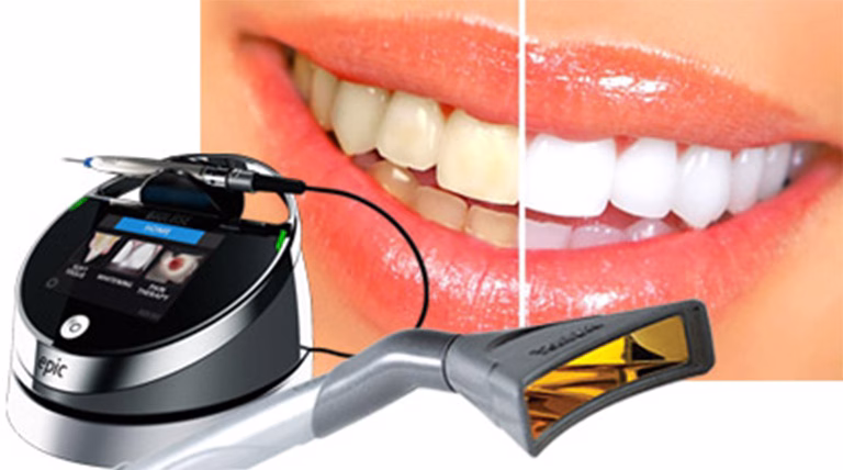 How Laser Teeth Whitening Can Benefit Your Smile