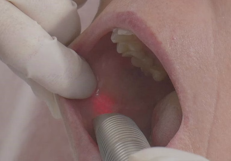 Intraoral Laser Face Rejuvenation